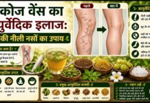 वैरिकोज वेंस का आयुर्वेदिक इलाज: पैरों की नीली नसों का उपाय वैरिकोज वेंस का आयुर्वेदिक इलाज: पैरों की नीली नसों का उपाय