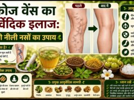 वैरिकोज वेंस का आयुर्वेदिक इलाज: पैरों की नीली नसों का उपाय वैरिकोज वेंस का आयुर्वेदिक इलाज: पैरों की नीली नसों का उपाय